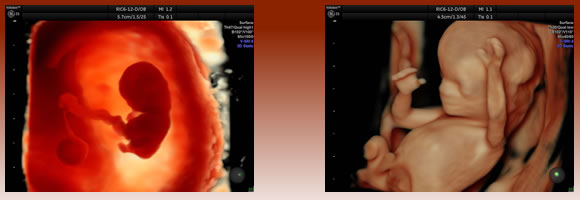 4D超音波診断装置画像